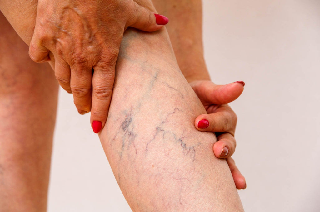 What are Varicose Veins and how can they be treated?