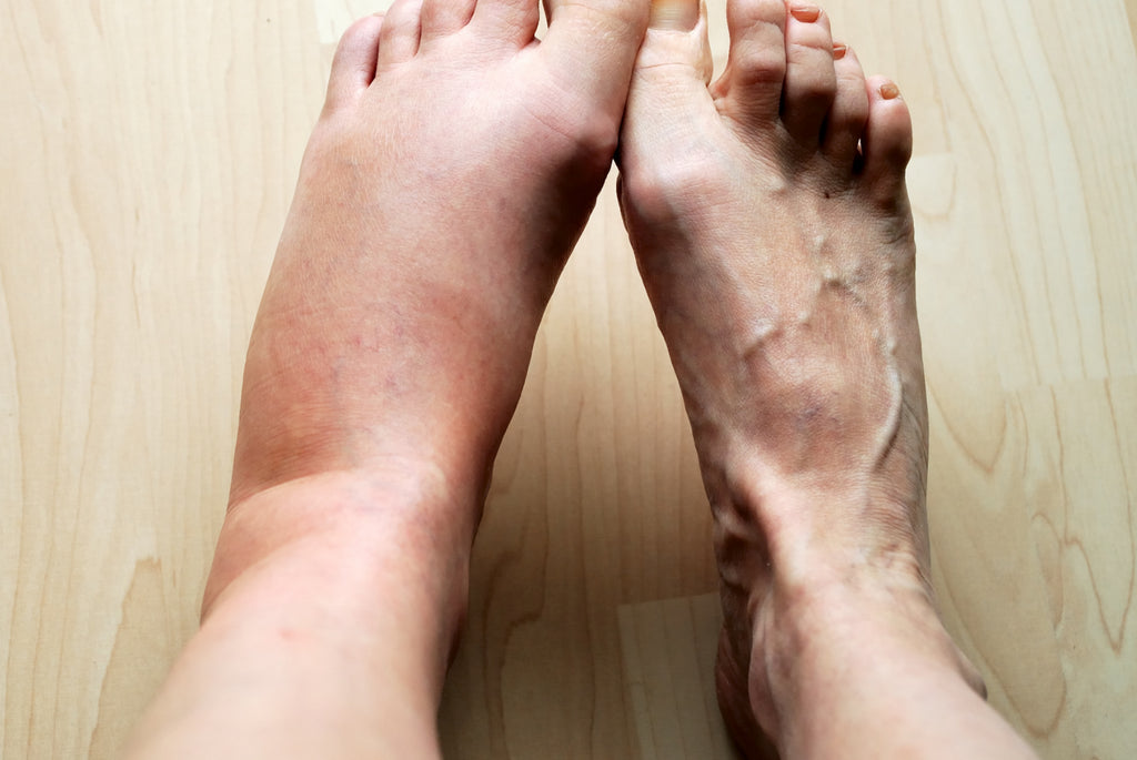 What is Edema?