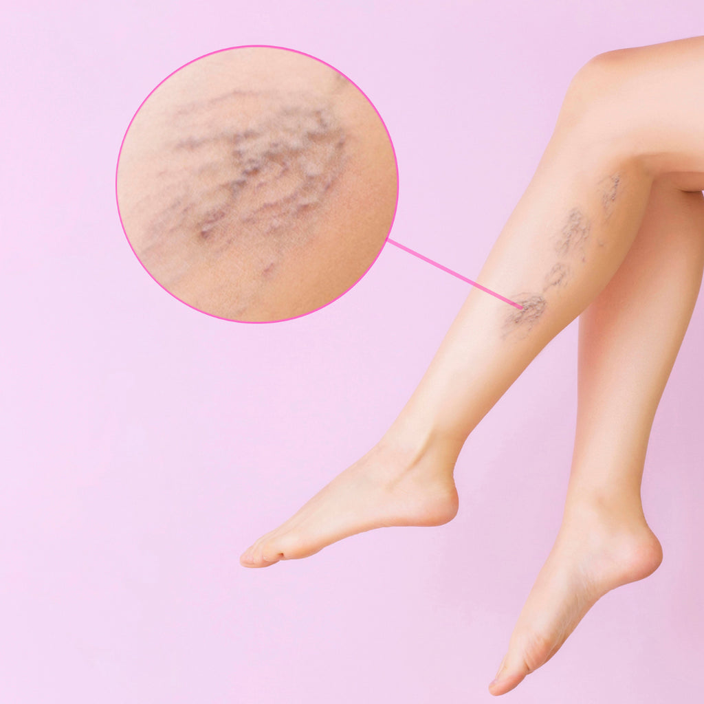 6 Easy lifestyle changes to help with Varicose Veins